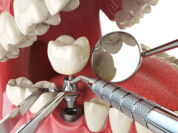 Urgent Tooth Repair in FL